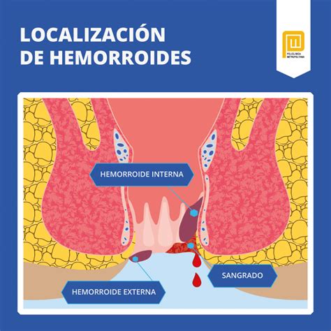 sexo anal y hemorroides|GUÍA SOBRE SALUD SEXUAL Y PATOLOGÍA。